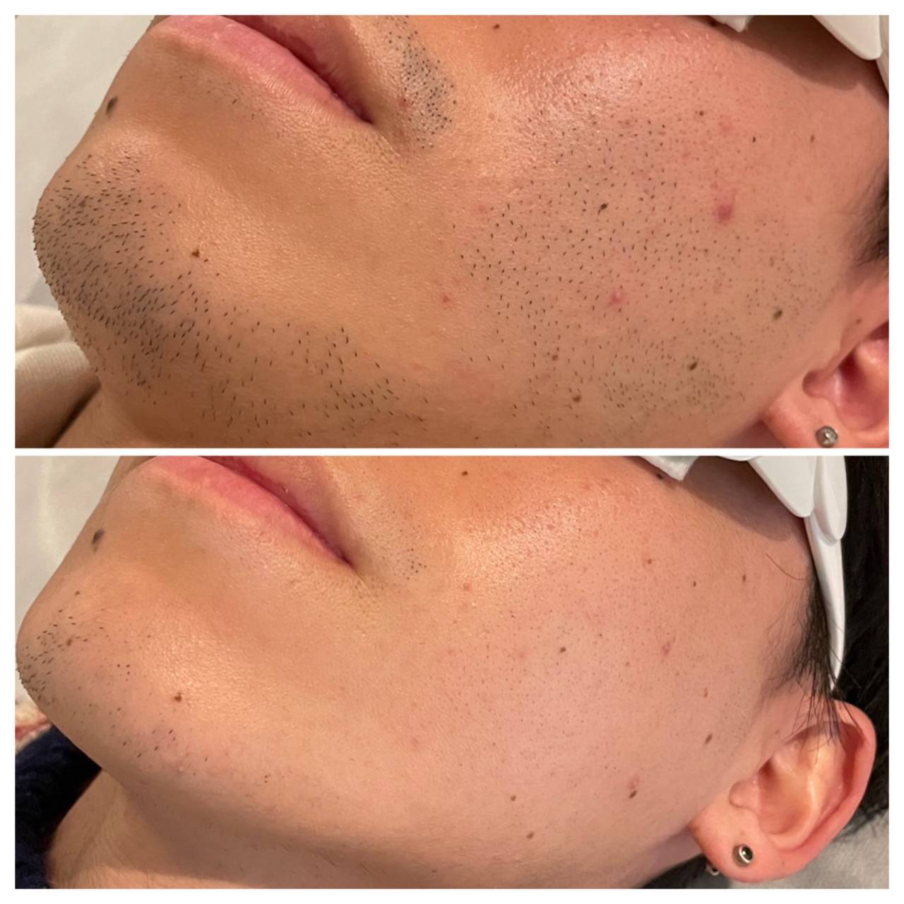 ヒゲ脱毛 BeforeAfter