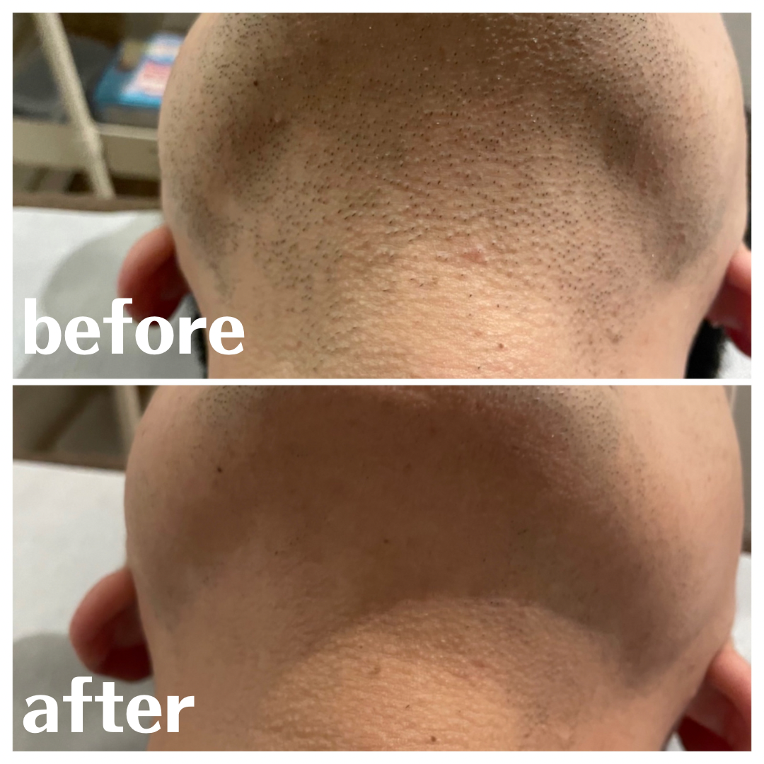 ヒゲ脱毛 BeforeAfter