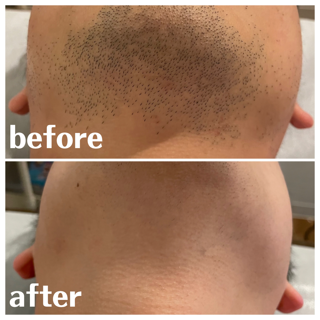 ヒゲ脱毛 BeforeAfter