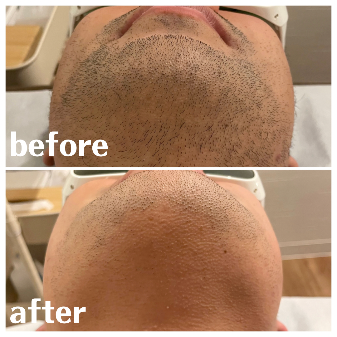 ヒゲ脱毛 BeforeAfter