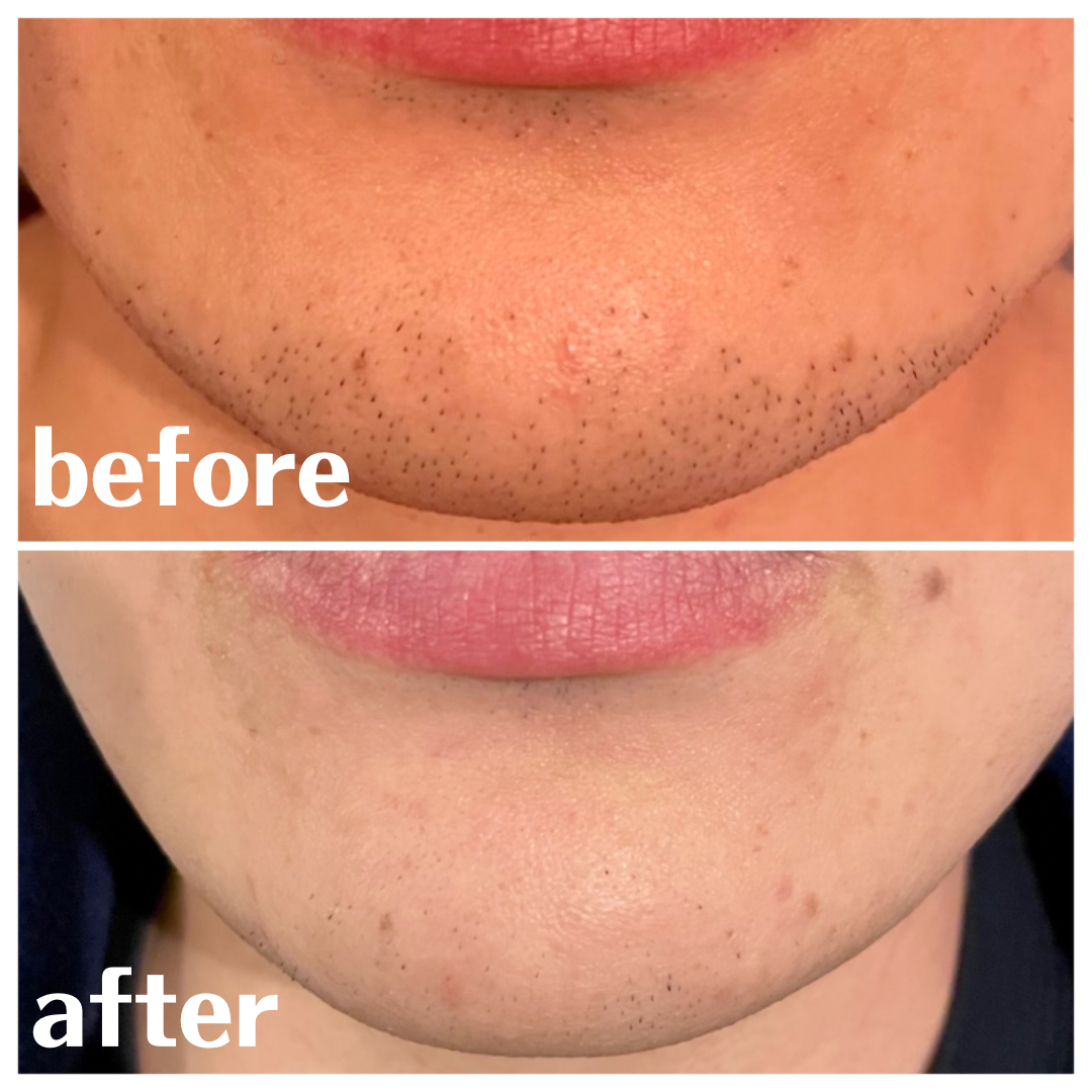 ヒゲ脱毛 BeforeAfter