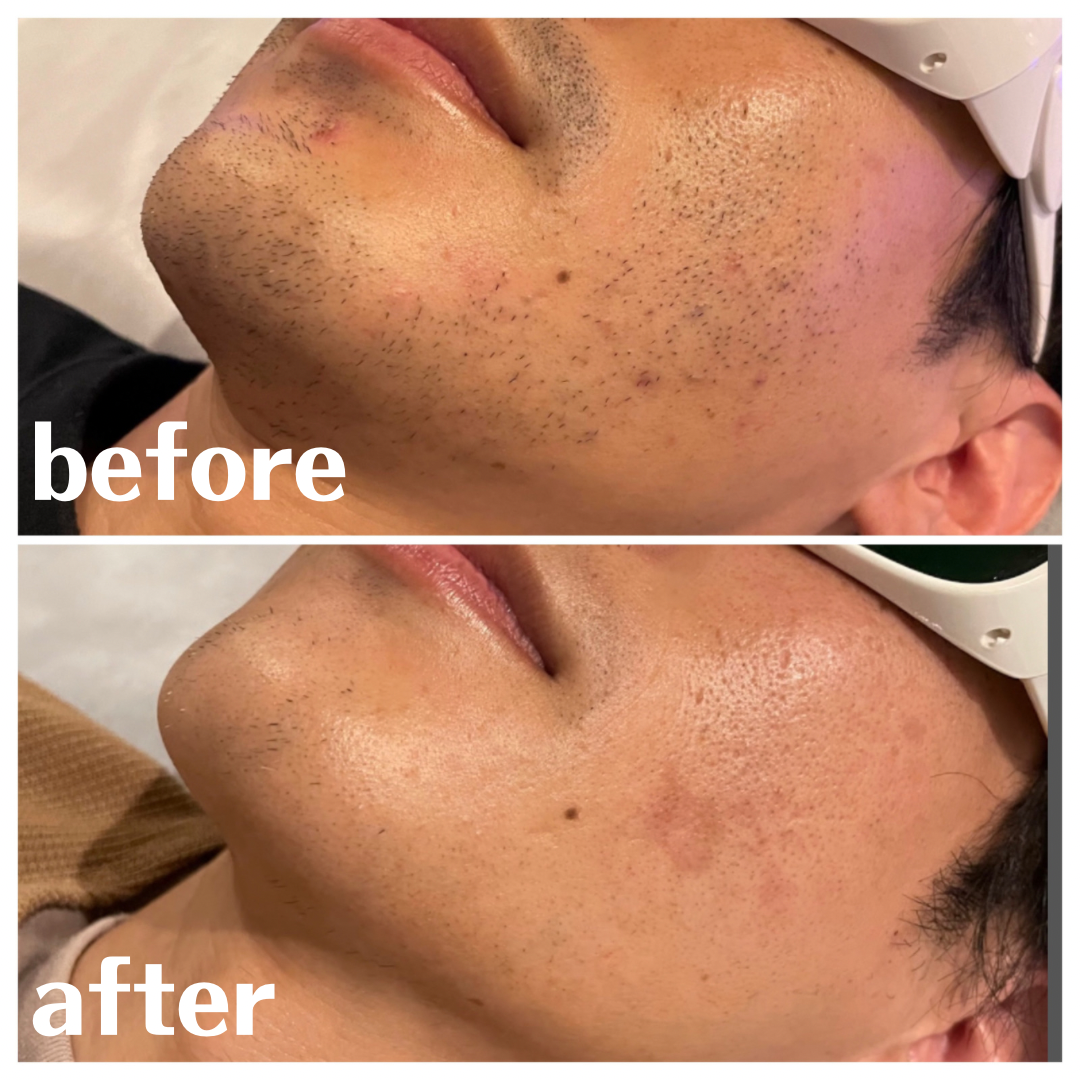 ヒゲ脱毛 BeforeAfter