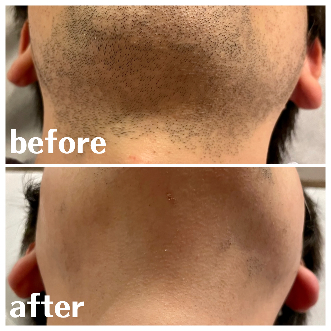 ヒゲ脱毛 BeforeAfter