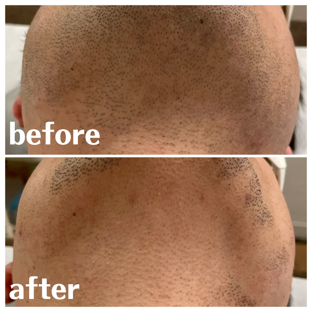 ヒゲ脱毛 BeforeAfter