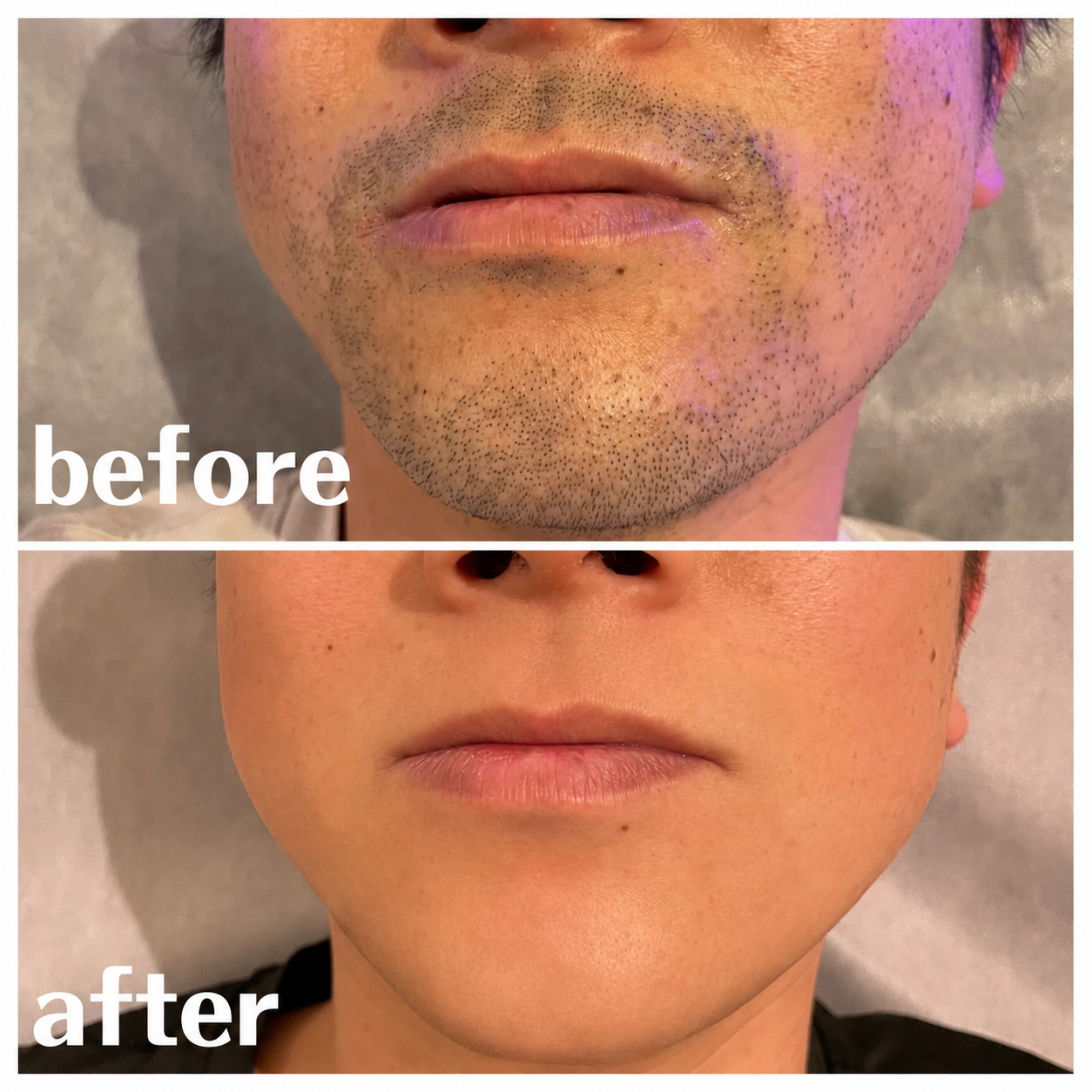 ヒゲ脱毛 BeforeAfter