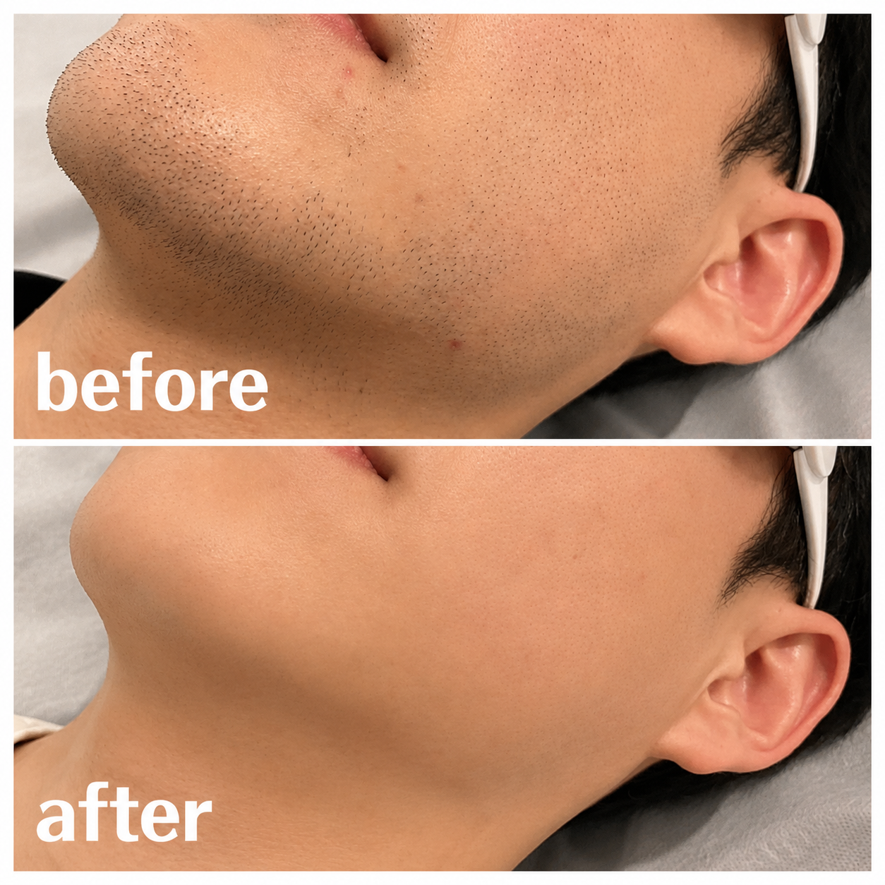 ヒゲ脱毛 BeforeAfter