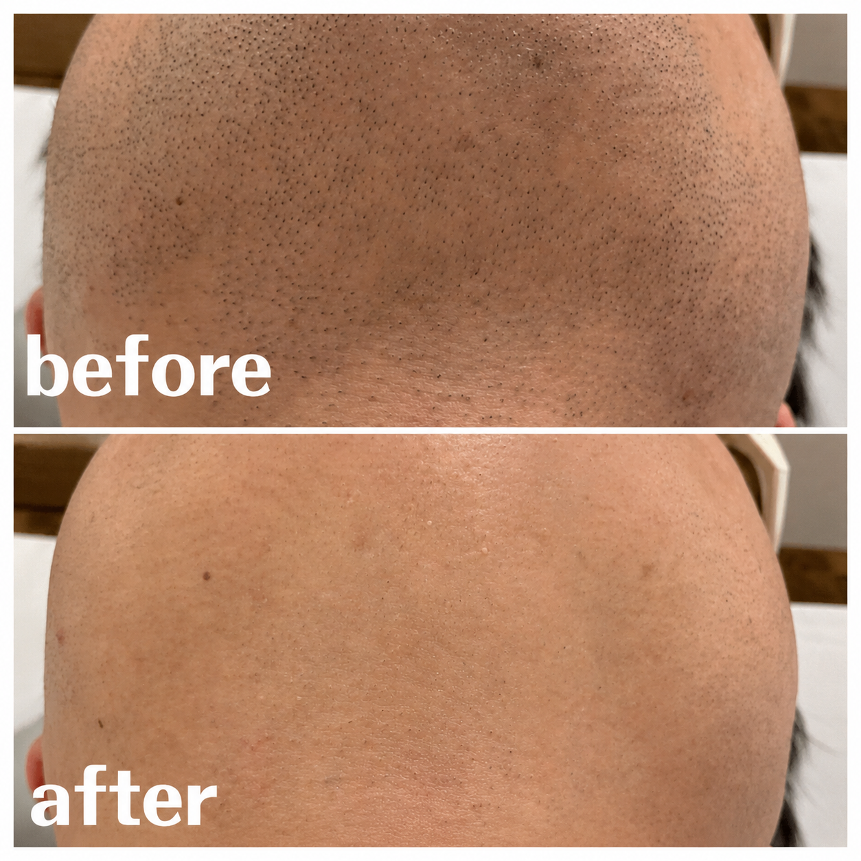 ヒゲ脱毛 BeforeAfter