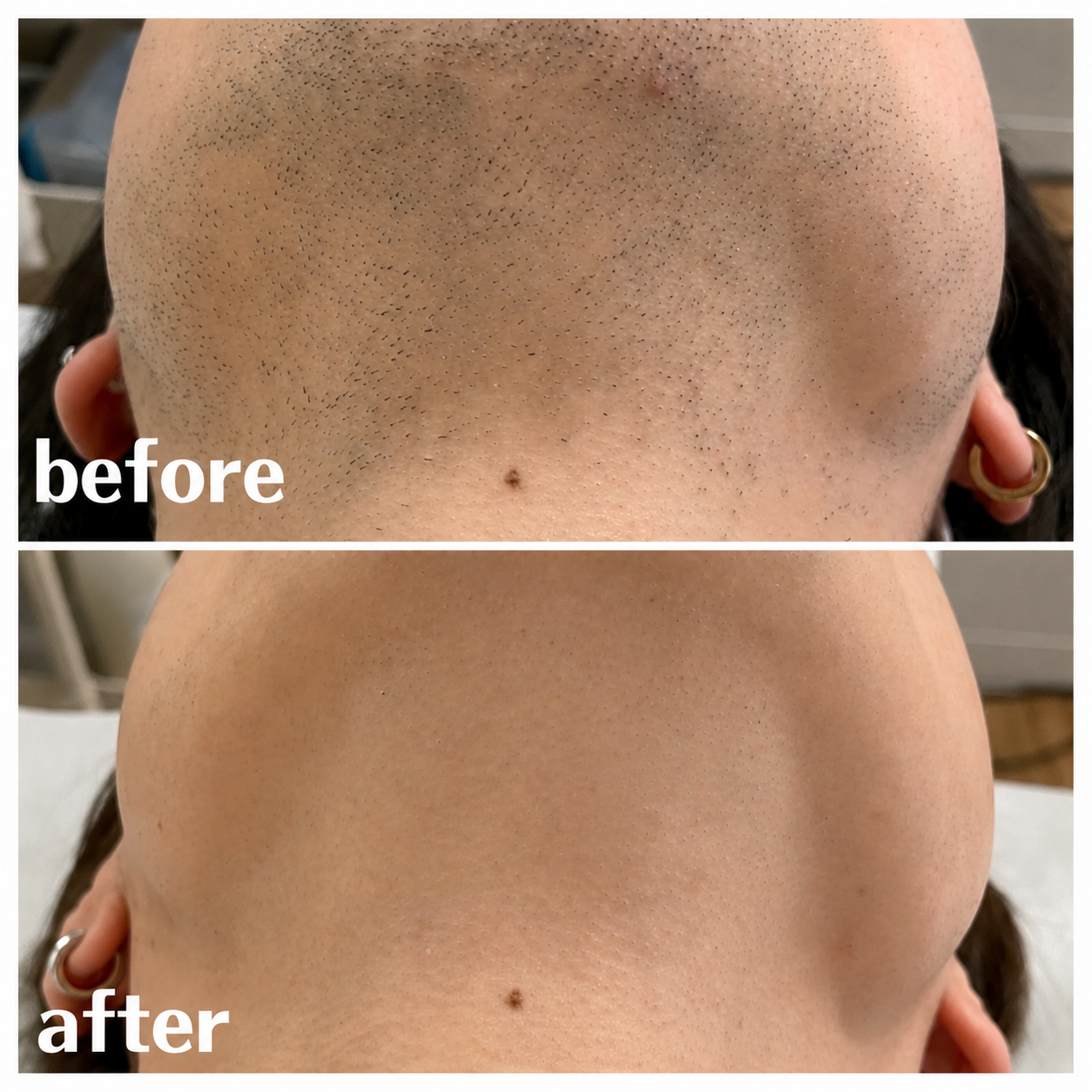 ヒゲ脱毛 BeforeAfter